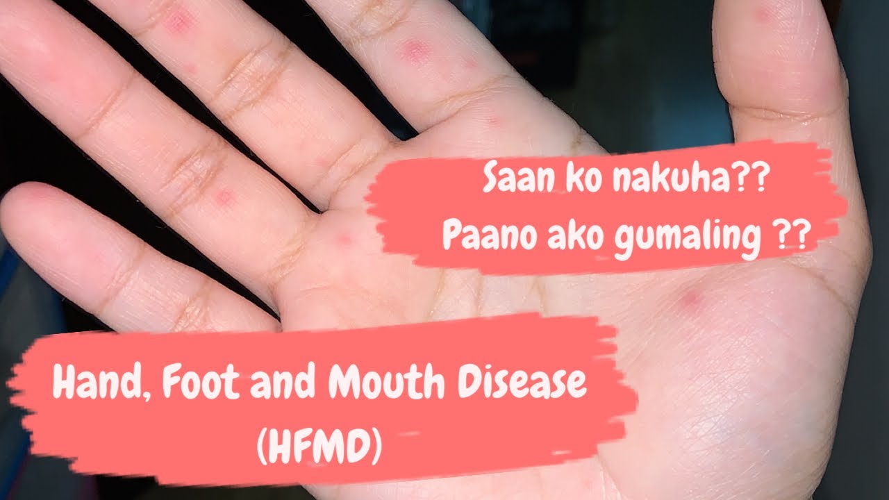 Hand, Foot and Mouth Disease (HFMD) Signs and Symptoms Paano ako
