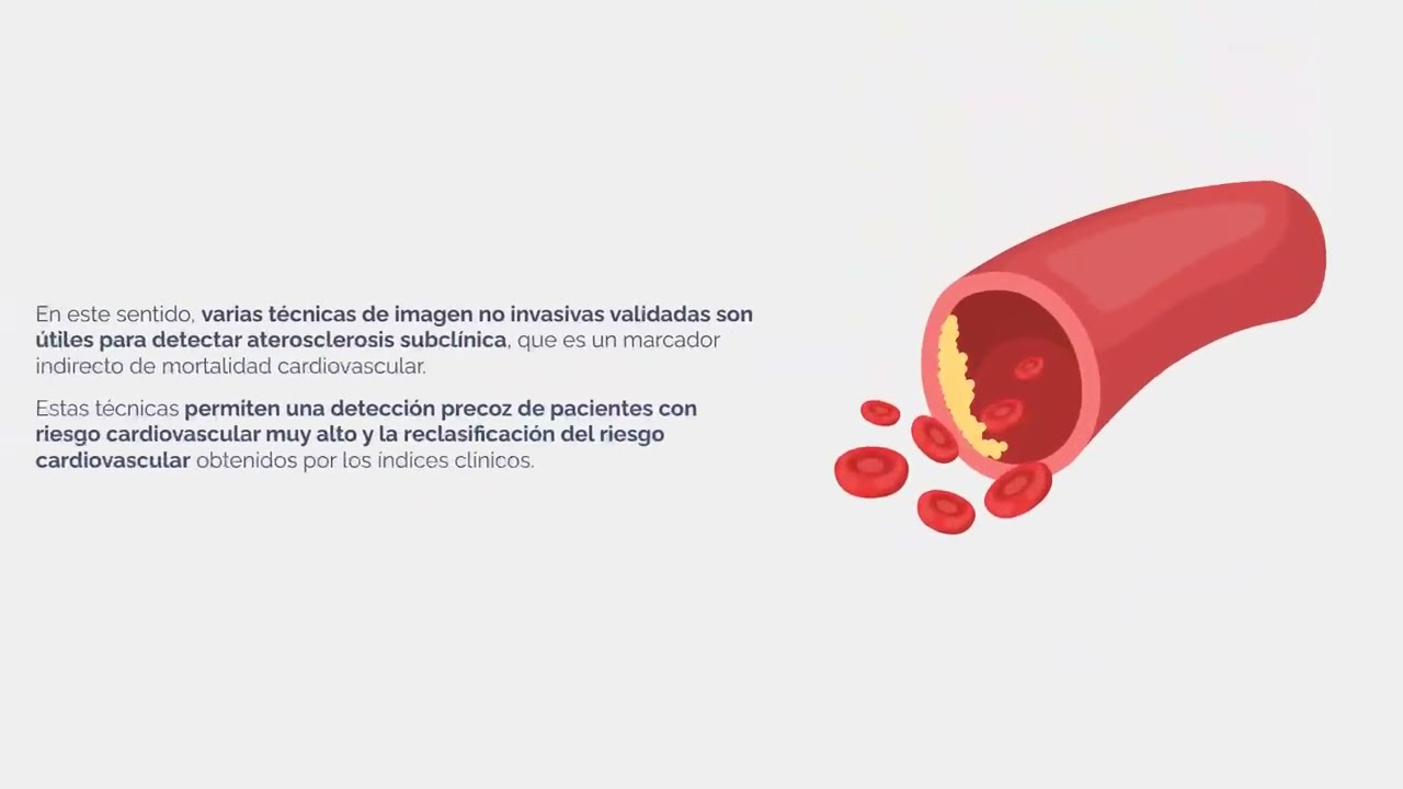 Caso clínico:Ecografía carotídea en una consulta de riesgo cardiovascular en enfermedades reumáticas