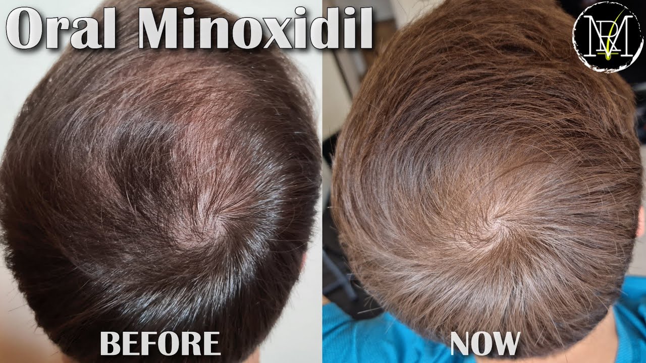 Oral Minoxidil (Loniten) Results in 10 Months - YouTube