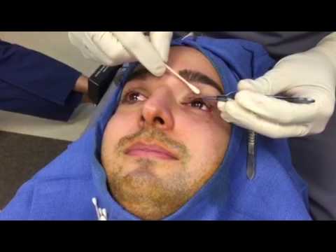 Video: Ptosis - Behandling, Orsaker, Kirurgi