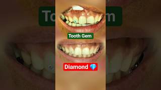 Dental Diamond In Nepal Teeth Diamond Gem Jewellery Dat Ma Hira Rakhne