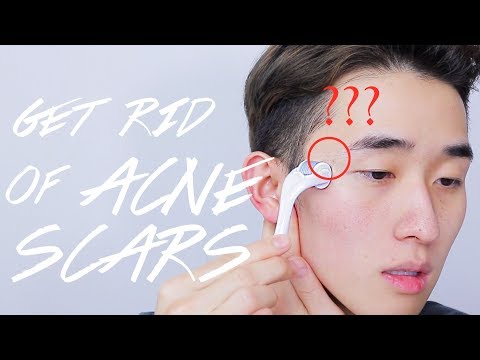 GET RID OF ACNE SCARS AT HOME! IT WORKS! Ivan Lam