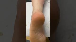 Experience The Satisfaction Of Professional Podiatry! Watch This Aussie Expert Fix Cracked Heels! #F