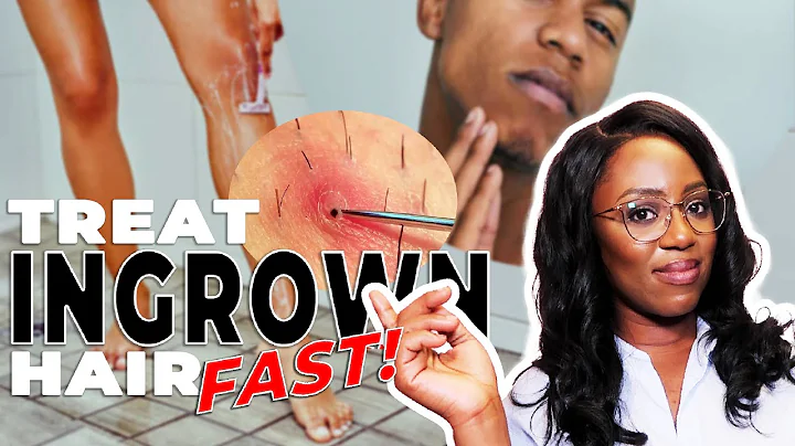How to Remove Ingrown Hairs and Razor Bumps - This ACTUALLY works!