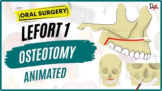 Lefort 1 Osteotomy