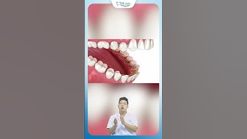 Phương Pháp Niềng Răng Mắc Cài Mặt Lưỡi  | Nha Khoa Minh Châu