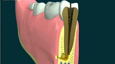 Quando comincia a fare effetto l'antibiotico per mal di denti?