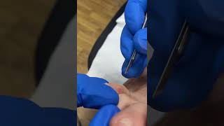 Painful Corn Between Toes - Watch a podiatrist remove corns and callus from the feet of a patient.c