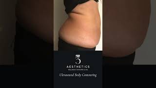Ultrasound Body Contouring #croydon #wellness #weightloss