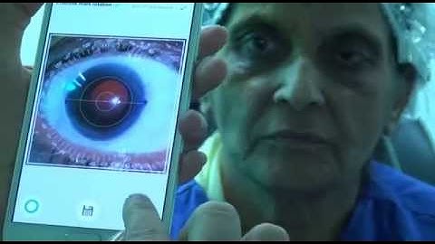 iToric Toric marking by Dr Sourabh D Patwardhan