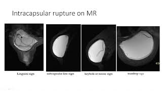 Diagnostic Workup in Breast Imaging - Implant Rupture on MR