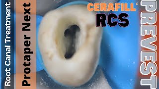 Root Canal Treatment in Maxillary Molar ⚪️ Protaper Next 🔵 Cerafill RCS Obturation