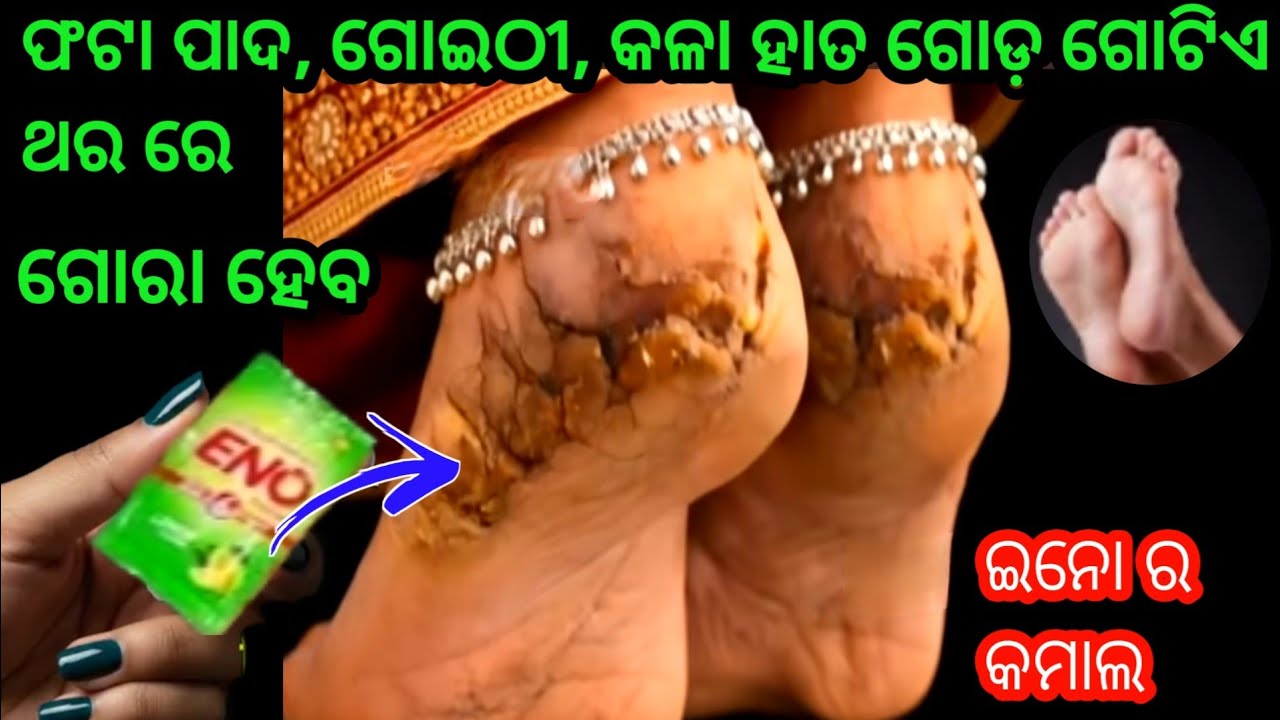 ପୁରା ଗ୍ୟାରେଣ୍ଟି! ମାତ୍ର ଗୋଟିଏ ଥର ରେ ଠିକ୍ ହୋଇଯିବ ଫଟା ପାଦ ଓ ଗୋଇଠୀ😱କଳା ହାତ ଗୋଡ଼। ପୁରା ଚମତ୍କାର।crack heel
