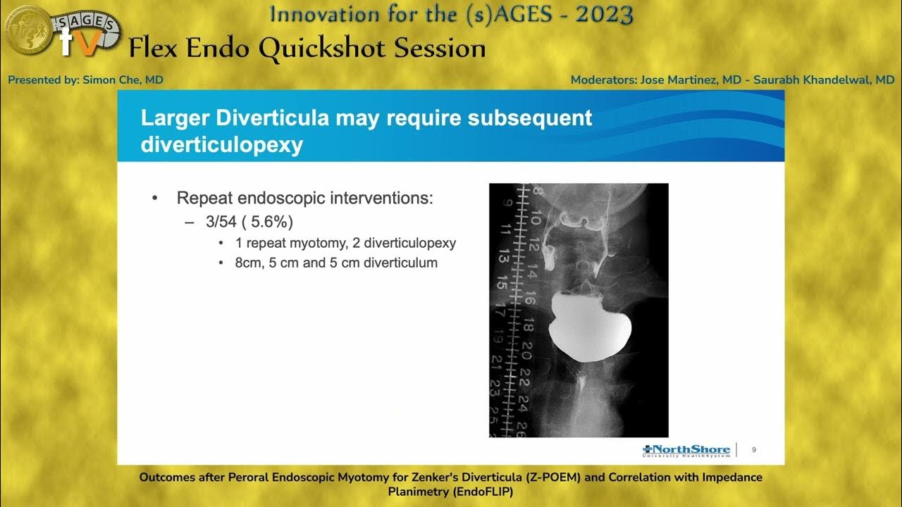 outcomes-after-peroral-endoscopic-myotomy-for-zenker-s-diverticula-z