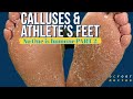 Calluses and Athlete's Feet: No One is Immune Part 2