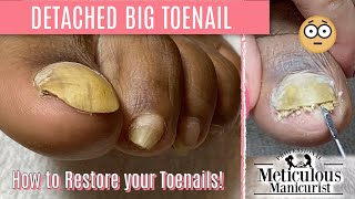 👣How To Pedicure Transformation for Men on Detached Toenails👣