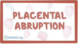 Placental abruption - causes, symptoms, diagnosis, treatment, pathology