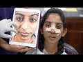 Nose Surgery Experience. Rhinoplasty, Cleft Nose with Collapsed Nose