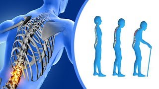 المرض الصامت  ..... هشاشة العظام   ، Osteoporosis