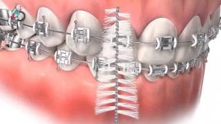 تعليمات العناية بجهاز تقويم الاسنان و تنظيف الاسنان . دكتور بلال ابوزيد