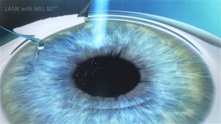 LASIK - Dr Castillo