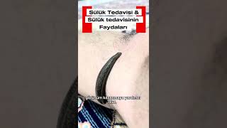 Sülük Tedavi̇si̇ & Faydalari Nelerdi̇r ?