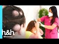 Hermanas presentan bultos en sus cabezas  | Dra. Sandra Lee: Especialista en piel | Discovery H&H