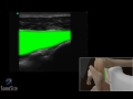 How To: Shoulder Injection Lateral Approach 3D Video
