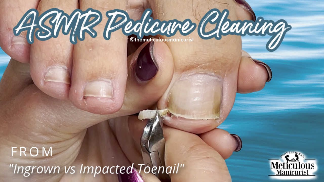 👣ASMR Pedicure Cleaning💆‍♀️Ingrown vs Impacted Toenail👣