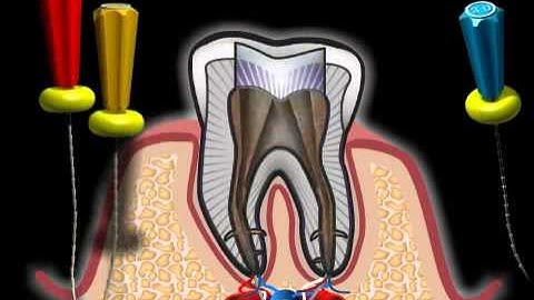 Paper Points for a perfect root canal treatment
