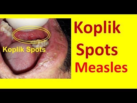 Koplik Spots in Measles