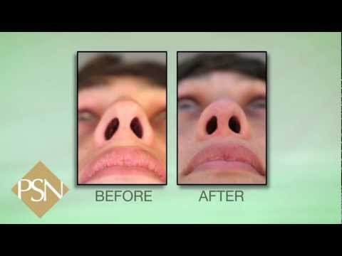 Video thumbnail: Rhinoplasty and Septoplasty · NassifMD®