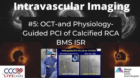 Watch Live OCT-and Physiology-Guided PCI of Calcified RCA BMS ISR