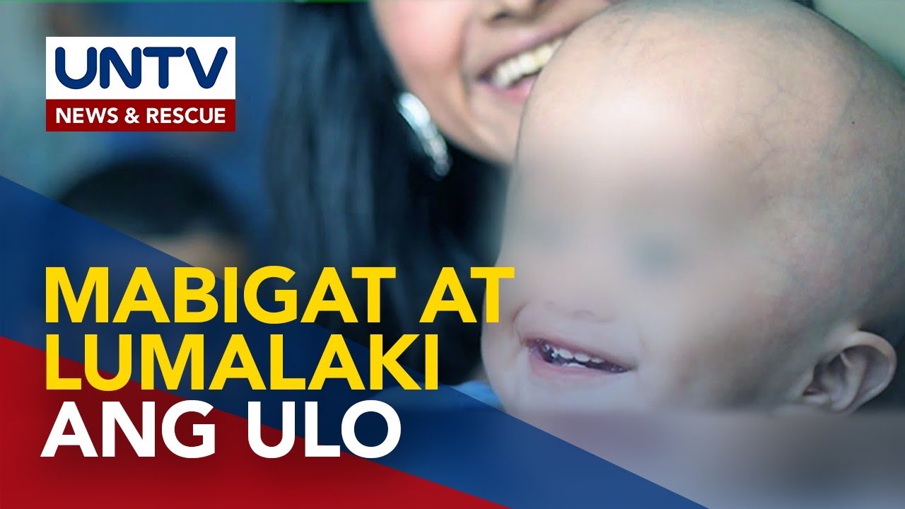 ALAMIN: Hydrocephalus sa mga sanggol, ano ang senyales at paano maaagapan?