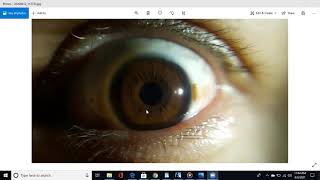 Download Mp3 Hematogenic (Brown) Iris Gudang lagu Download Mp3 Hematogenic (Brown) Iris