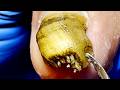 Very Long Onychomycosis Nails, Like Teeth!【Xue Yidao】