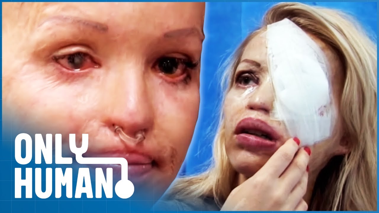 Katie Piper Faces More Surgery On Her Eyelids, Leaving Her Temporarily Blind | Only Human