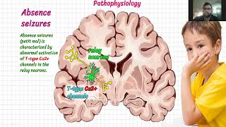 Epilepsy part 1