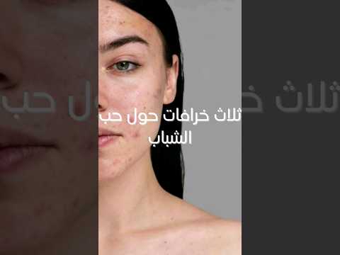 ثلاث خرافات حول حب الشباب يجب معرفتها Skincare Acne Beauty