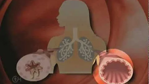 What is Asthma? - The Children's Hospital of Philadelphia (2 of 4)