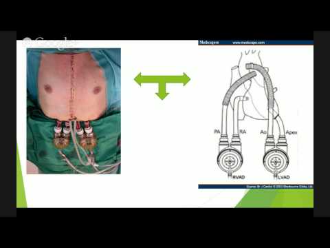 Vídeo: Presión Arterial Arterial Pulsátil Que Imita La Apertura De La Válvula Aórtica Durante El Soporte De LVAD De Flujo Continuo: Informe De Un Caso