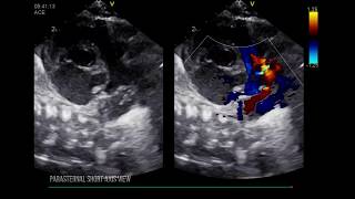 PATENT DUCTUS ARTERIOSUS: LEFT HEART DILATION.