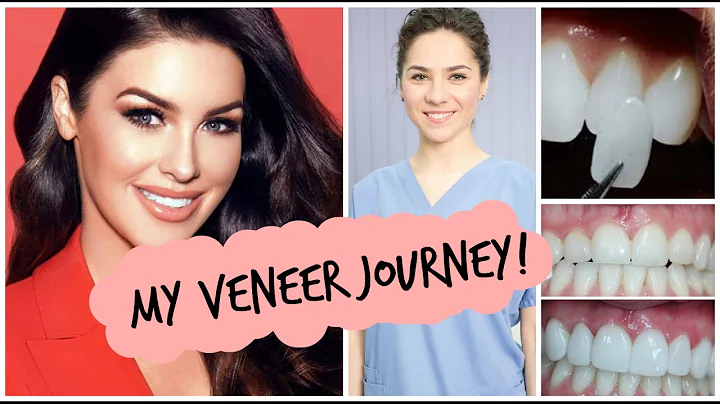 My Veneer Journey | Suzanne Jackson