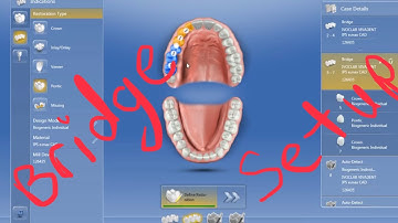 Setup CEREC Bridges 2-4, 5-7, Crowns 8, 9