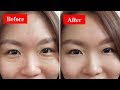 How To Get Rid Of Your Eye Bags Fast & Naturally At Home!