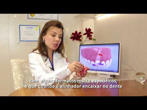 Vídeo: Quando os anexos são removidos invisalign?