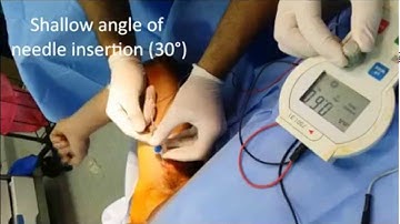 Axillary brachial plexus block - PNS