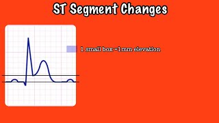 ST Elevation and Depression on an EKG Rhythm Strip
