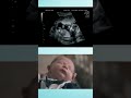 3D Animation on Normal Delivery #meddco #healthcare