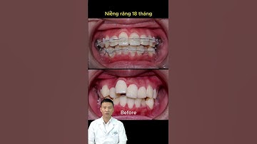 Tình Trạng Răng Lệch Lạc Ngoài Cung | Bác Sĩ Yên